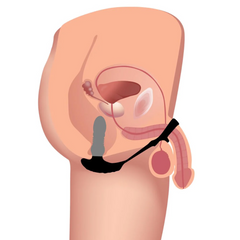 Anatomical diagram illustrating prostate-targeted placement of the anal plug with cock and ball ring